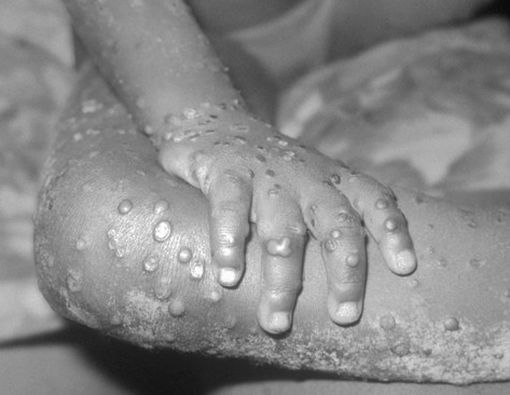 Antisipasi Cacar Monyet Masuk ke Batam, Ini yang Perlu Dilakukan