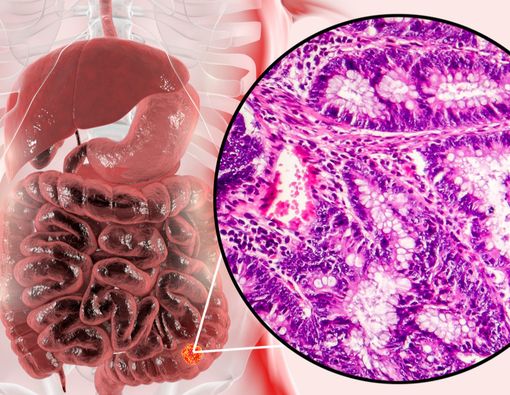 Mengapa Kanker Usus Bisa Sebabkan Badan Kurus?