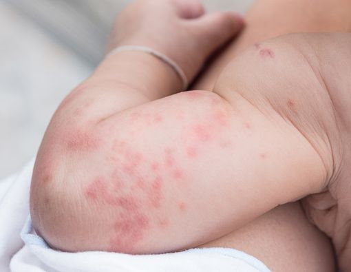 Alergi Susu Bikin Anak Biduran, Ini Solusinya