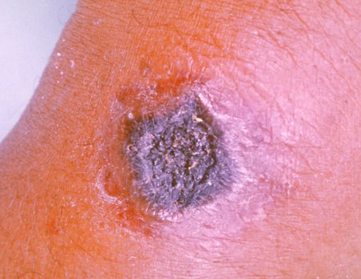 Kenali Ciri-ciri Kulit Kena Antraks