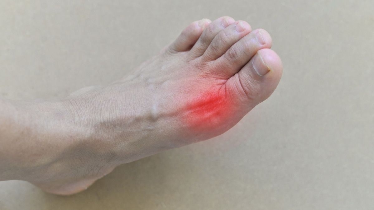 Mengenal Tophi, Komplikasi Asam Urat Karena Tidak Diobati - KlikDokter