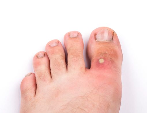 Cara Tepat Mengobati Bisul pada Penderita Diabetes