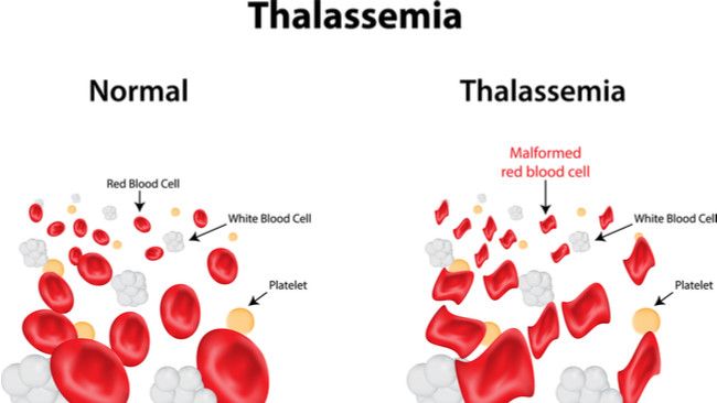 Yuk, Mengenal Thalassemia Lebih Dekat