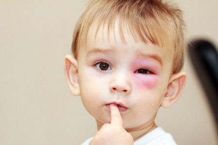Pertolongan Pertama Jika Si Kecil Tersengat Lebah