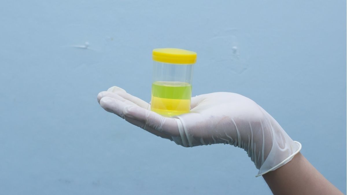 Hasil Tes Urine Epitel Positif, Apa Artinya dalam Medis?