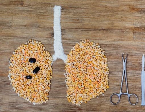 Mengenal Operasi Bulektomi untuk Mengobati Pasien PPOK