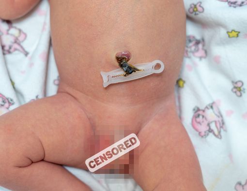 Solusi untuk Anak dengan Ambiguous Genitalia, Haruskah Selalu Operasi?