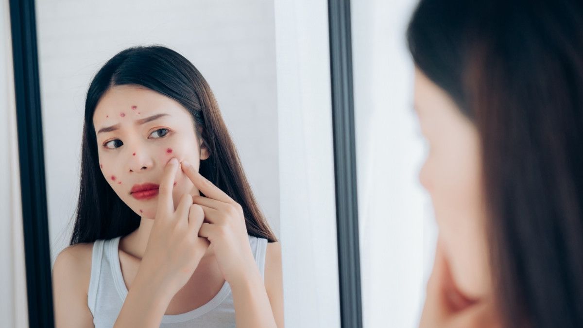 Mitos Tentang Jerawat yang Tak Perlu Dipercaya