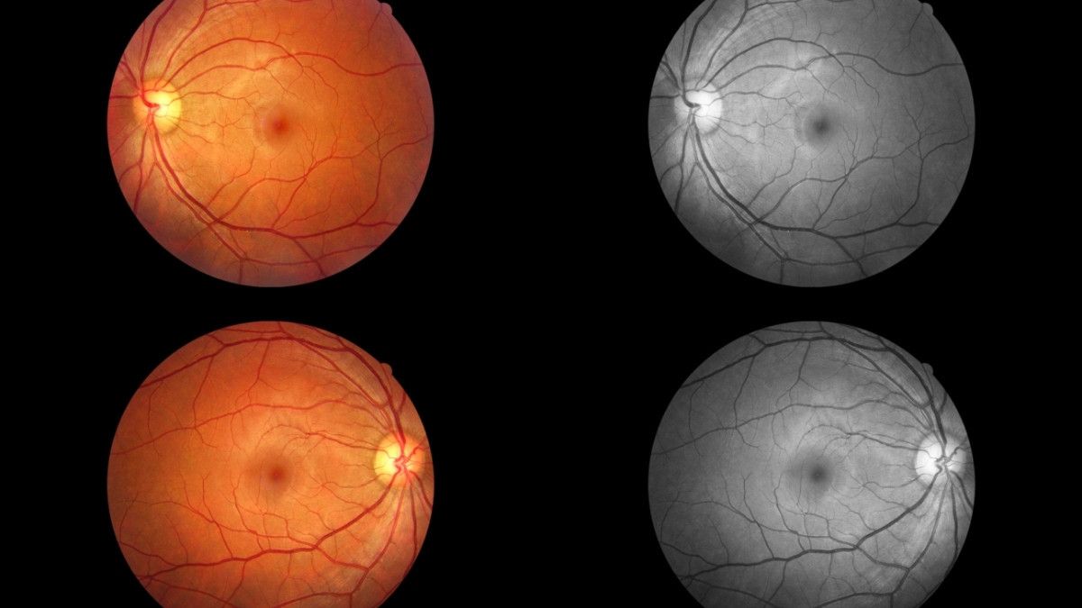 Faktor Genetik Penyebab Utama Retinoblastoma, Benarkah?
