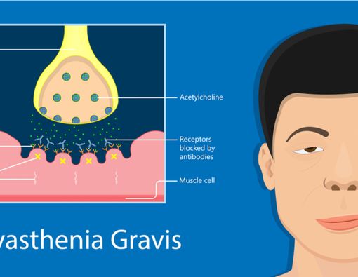 Hidup Normal dengan Myasthenia Gravis, Bagaimana Caranya?