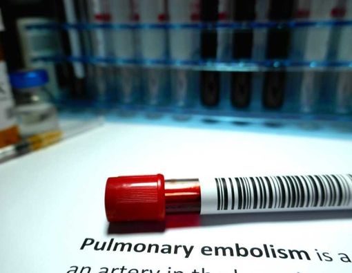 Cara-Cara Mencegah Emboli Paru