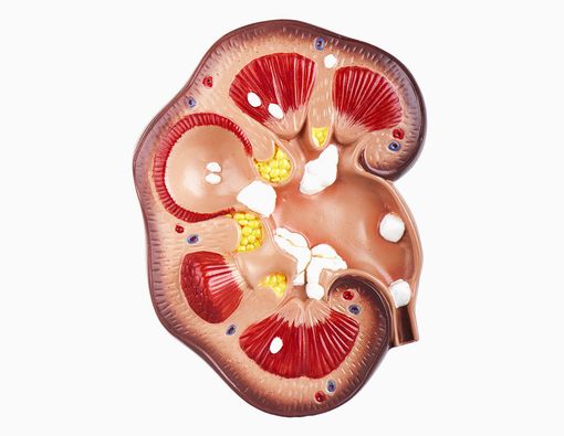 Deretan Makanan dan Minuman Pemicu Batu Ginjal