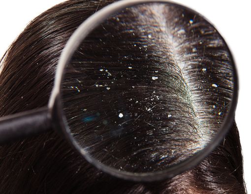 Ketombe Menyerang? Ini Cara Tepat untuk Mengatasinya