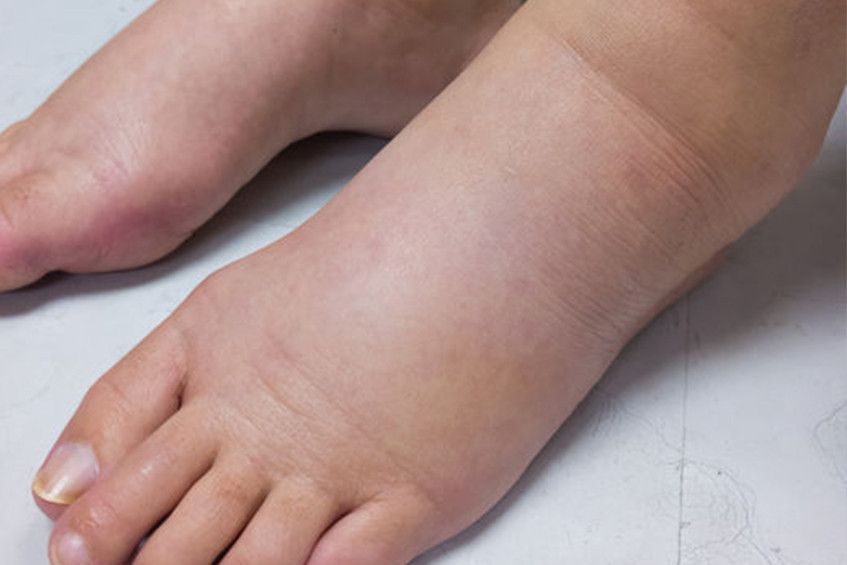Krisis Filariasis