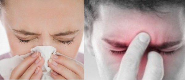 Apa Bedanya Flu dan Sinusitis?