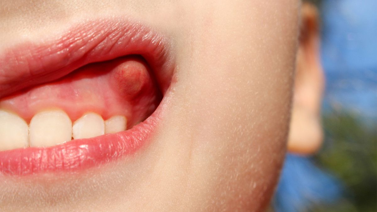 Awas, Penyakit Gusi Bisa Memicu Alzheimer!