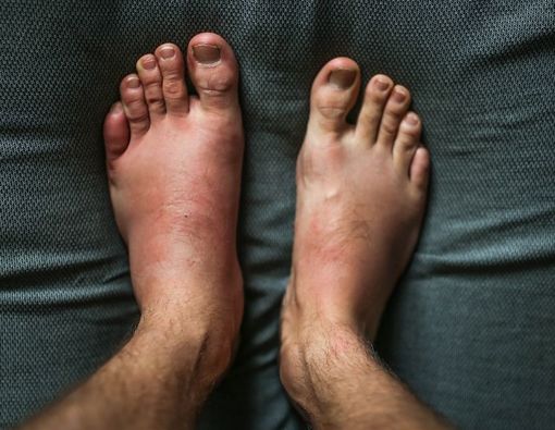 Jempol Kaki Anda Bengkak? Hati-Hati Gout