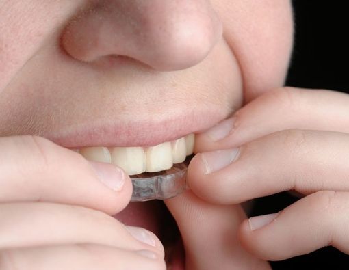 Penting! Ini Cara Membersihkan Retainer Gigi yang Benar