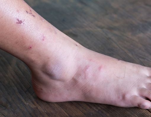 Kaki Charcot, Komplikasi Diabetes yang Berisiko Amputasi