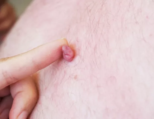 Penyebab Skin Tag dan Cara Efektif Menghilangkannya