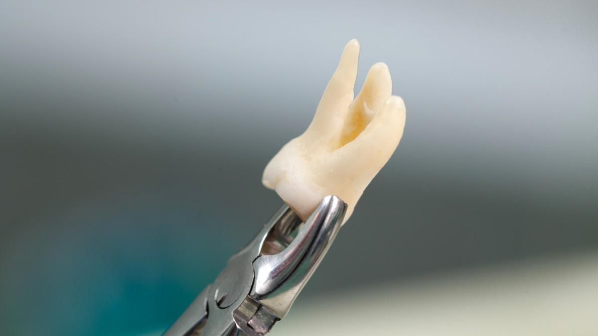 Kenali Berbagai Alat Pencabutan Gigi dan Fungsinya