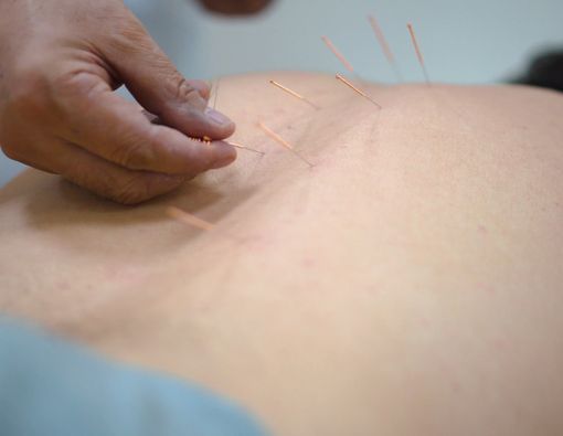 Benarkah Akupunktur Efektif untuk Atasi Obesitas?