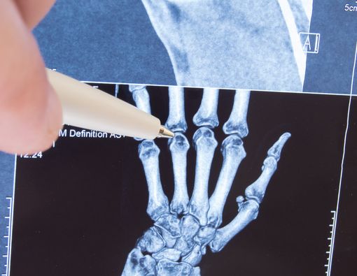 Cara Merawat Anak yang Mengalami Juvenile Rheumatoid Arthritis