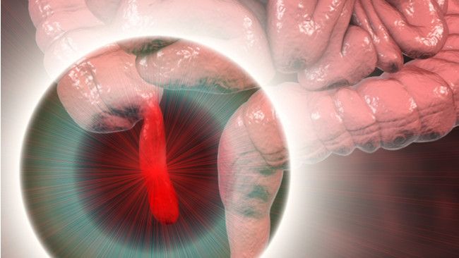 Yuk, Kenali Penyakit Usus Buntu Lebih Jauh! (Kateryna-Kon/Shutterstock)