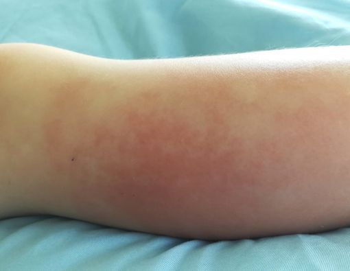 Hal yang Harus Anda Ketahui Tentang Kondisi Selulitis