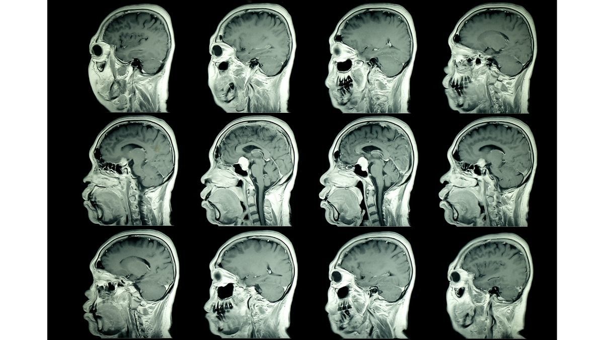 Efek Samping yang Mungkin Terjadi Pascaoperasi Kanker Otak