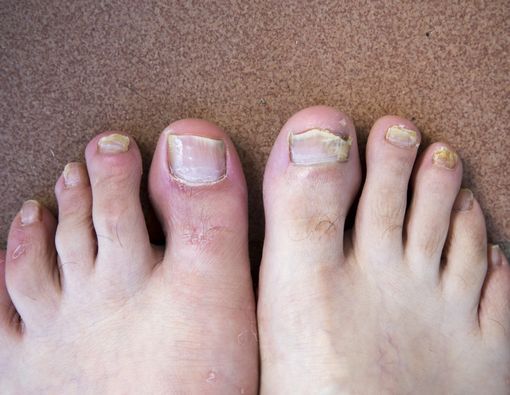 Jenis Jamur dan Gejala Infeksi yang Ditimbulkannya