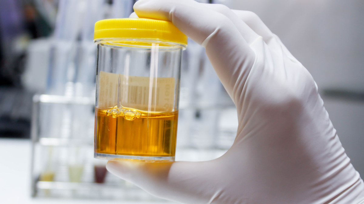 Proteinuria