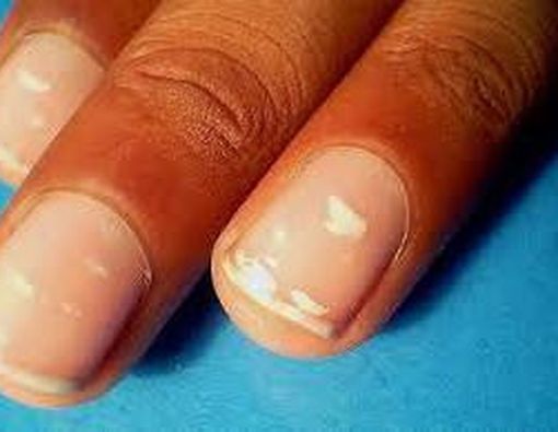8 Arti Tanda Kuku dengan Kesehatan Anda