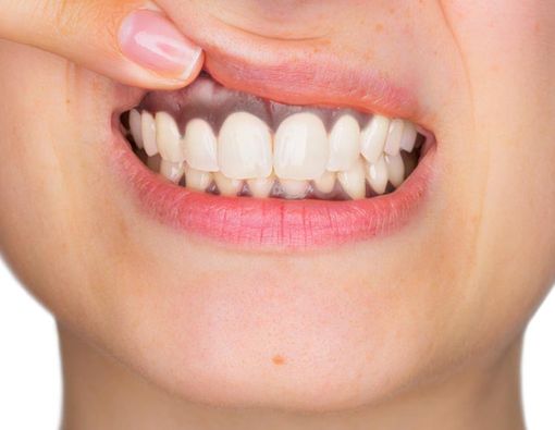 Inilah Penyebab Gusi Hitam yang Kamu Perlu Tahu