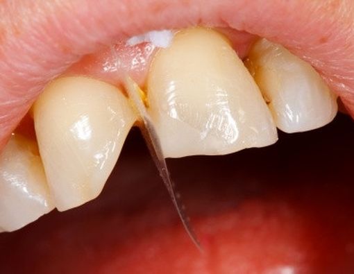 Pertolongan Pertama Pada Gigi Patah