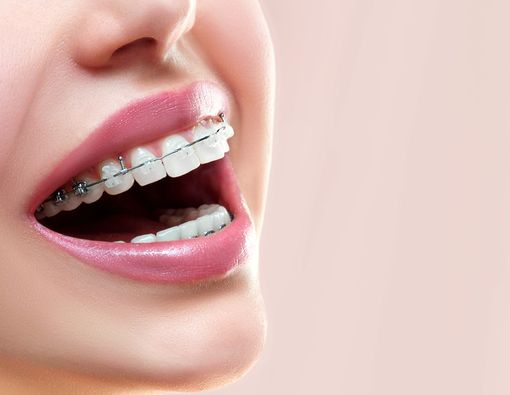 Awas, Behel Bisa Bikin Gigi Sensitif!