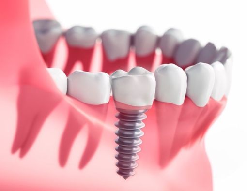 Komplikasi Implan Gigi yang perlu Anda Waspadai