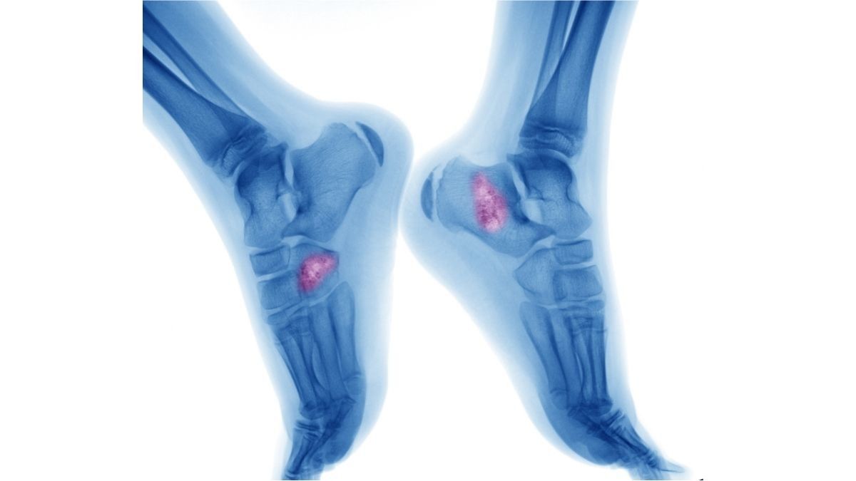 Nutrisi yang Baik Untuk Pasien Osteosarkoma