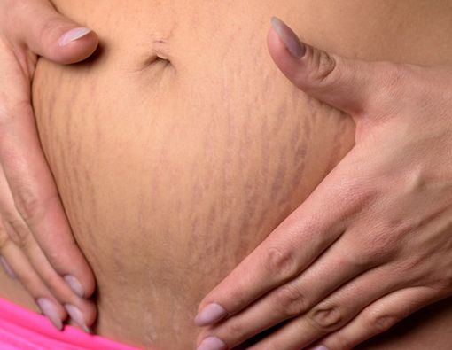 Stretch Mark