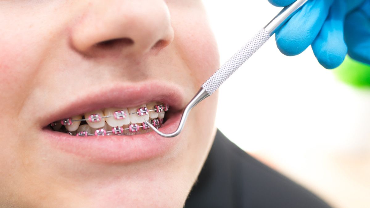 Dampak Negatif Kawat Gigi yang Perlu Anda Tahu