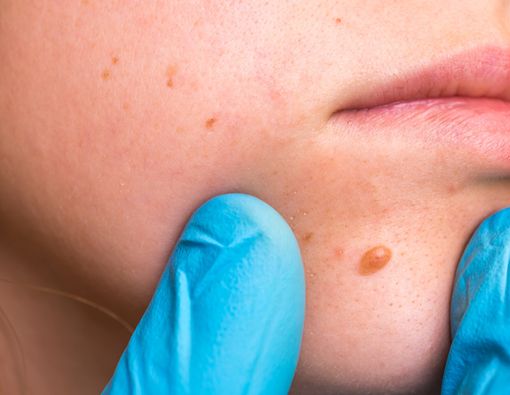 8 Kelainan pada Kulit yang Jadi Tanda Penyakit Serius