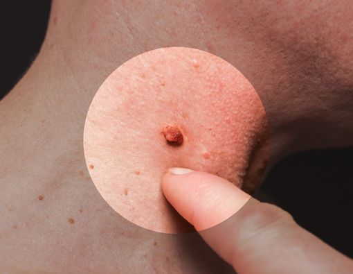 Kutil di Leher Bisa Menular, Ketahui Cara Menghindari dan Mengatasinya