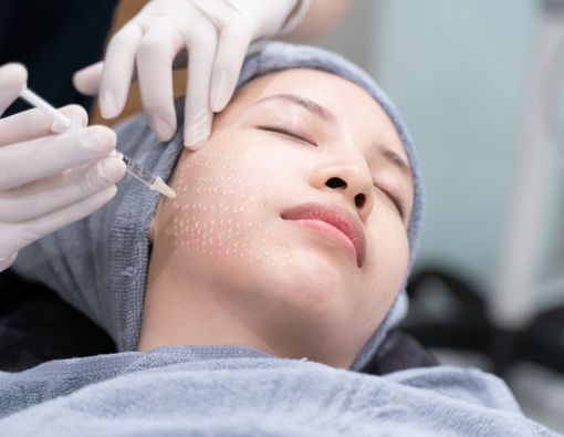 Mesotherapy: Manfaat, Prosedur, dan Efek Samping