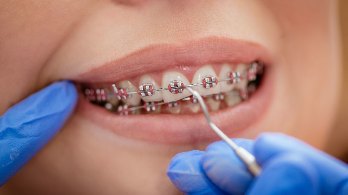 Ini Kondisi Gigi yang Perlu Pakai Behel, Apa Saja?