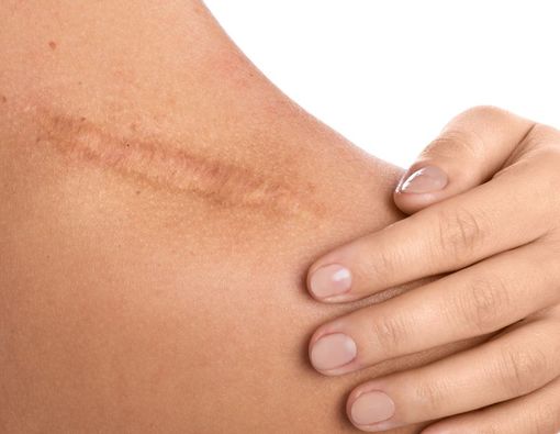 6 Cara Mencegah Keloid pada Bekas Luka