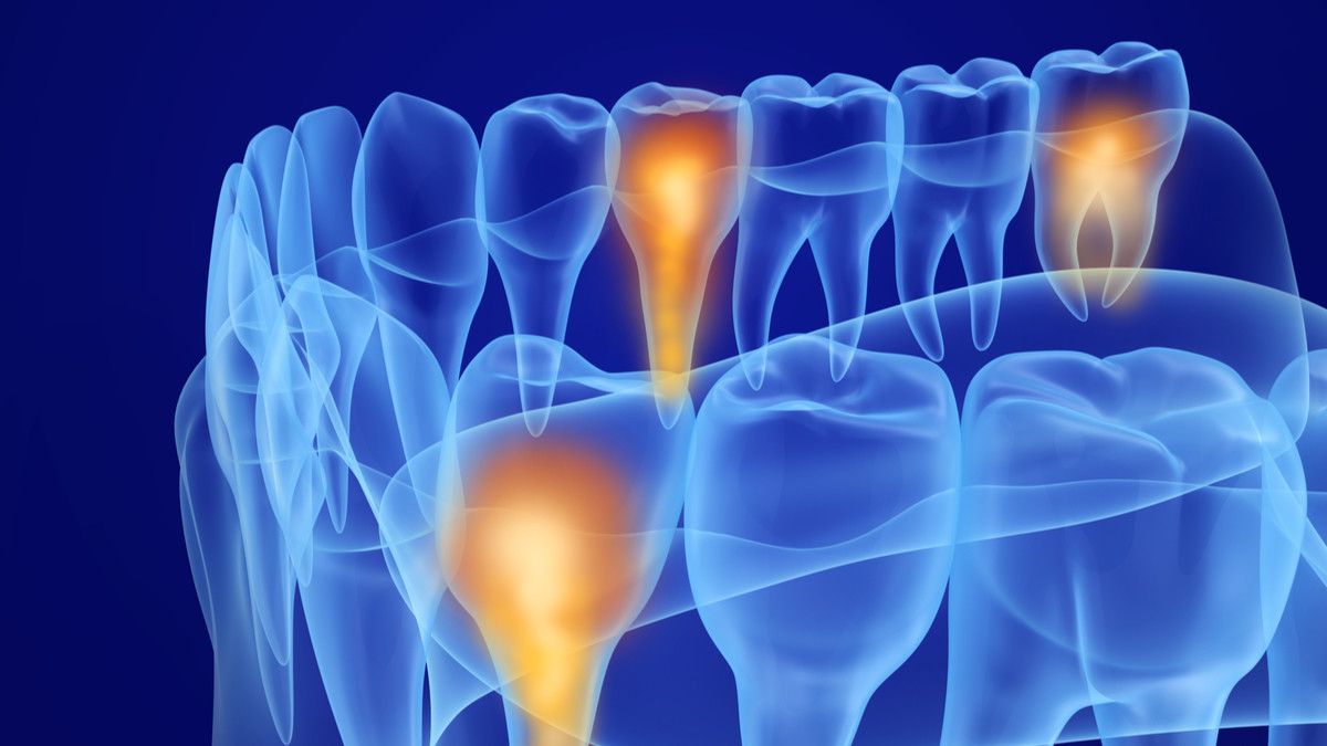 Mengenal Pulpotomi, Metode Bedah untuk Atasi Polip Pulpa di Gigi