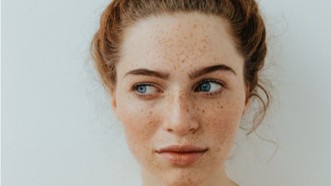 Fakta tentang Freckles yang Perlu Anda Ketahui