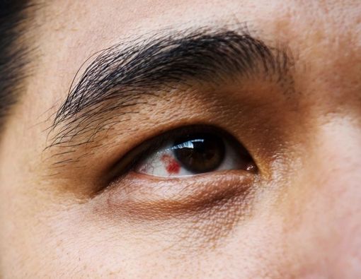 8 Penyebab Pembuluh Darah Mata Pecah, Berbahayakah?