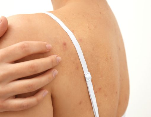 Jerawat di Punggung, Atasi dengan Cara Efektif Ini!