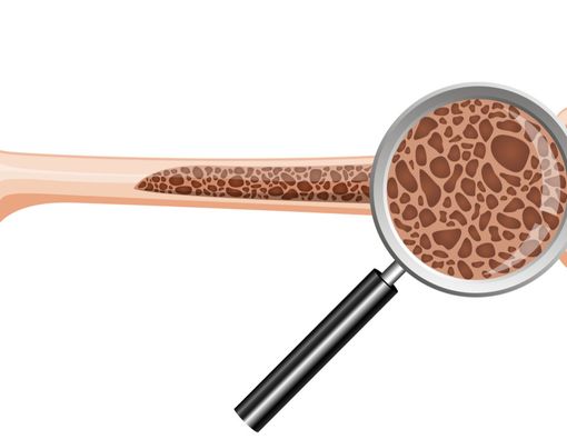 Osteoporosis dan Osteomalasia, Bagaimana Membedakannya?